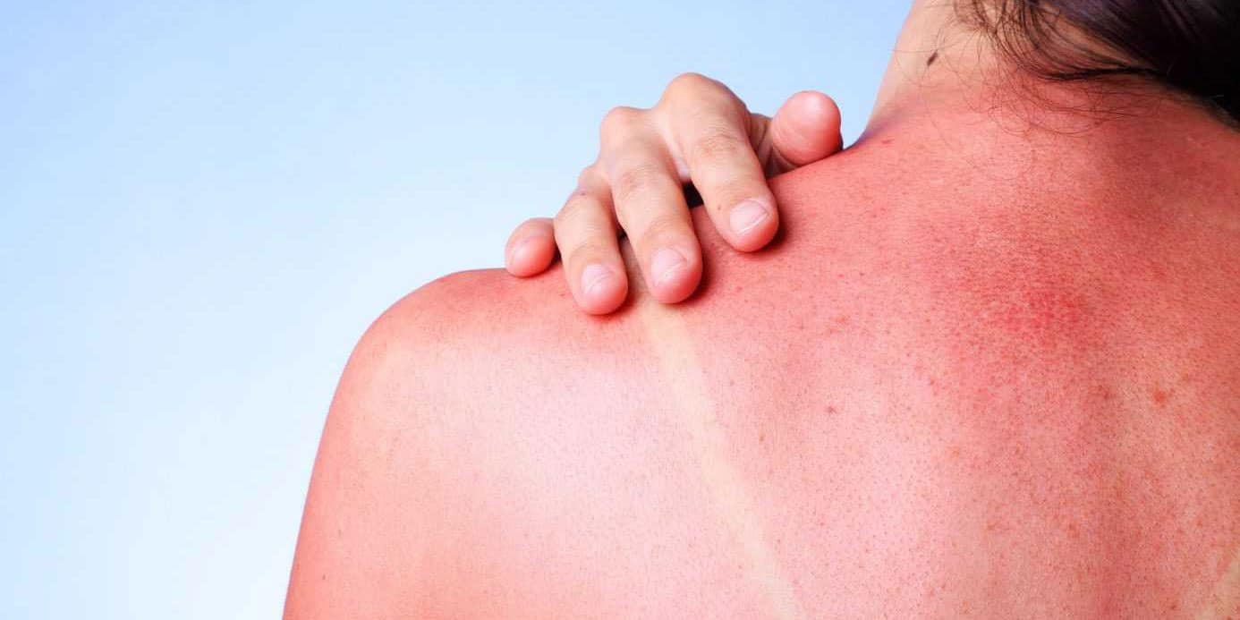 sunburn-repair-pensacola